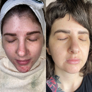 acne-results-skincare-facial-washington