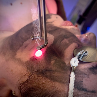 chrome-laser-vancouver-washington