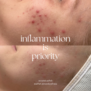 acne treatments in Vancouver Washington