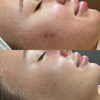 acne-results-skincare-facial-vancouver-washington