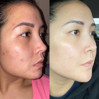 acne-results-skincare-facial-vancouver-washington