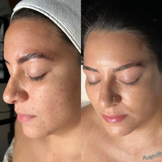 acne-results-skincare-facial-washington