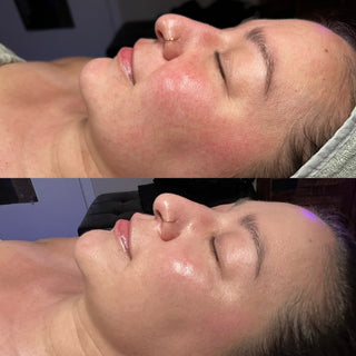 rosacea-results-skincare-facial-vancouver-washington