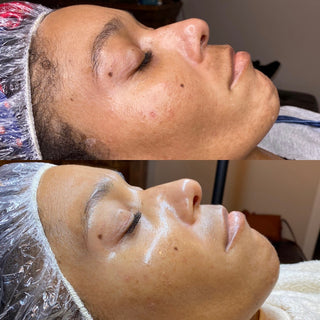 scarring-results-skincare-facial-vancouver-washington